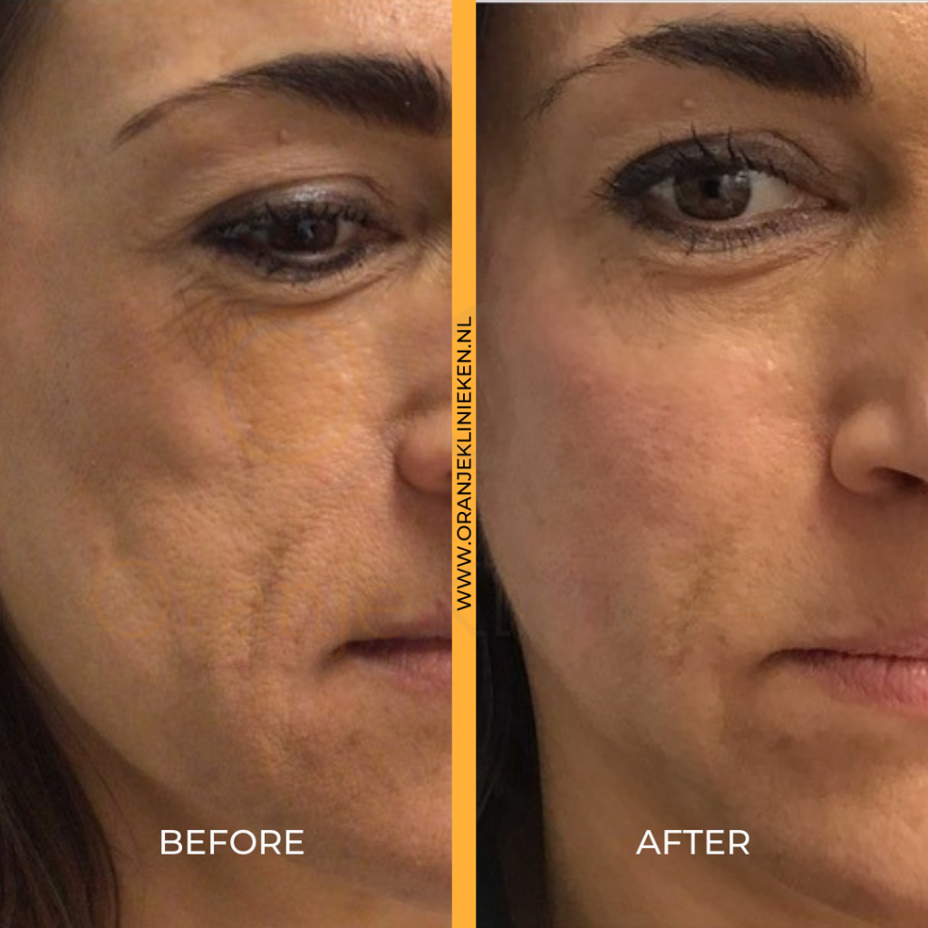 Filler midface