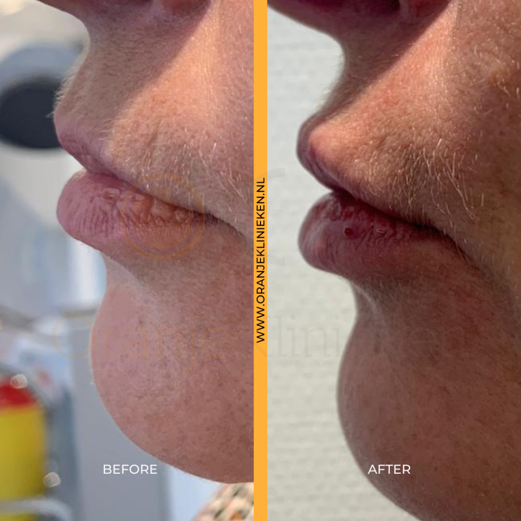 Lipfiller (2)