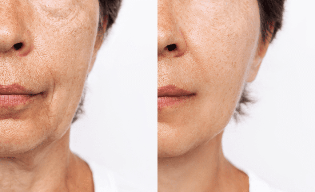 Radiesse before after